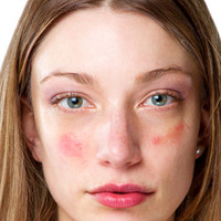 Duygusal travmalar cilt hastalığına neden oluyor