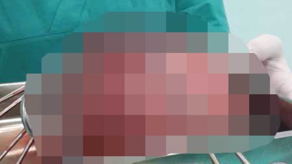 Rahminden 4 kiloya yakın miyom çıkarıldı