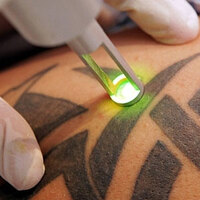 Dövmenizi sildirmek mi istiyorsunuz?