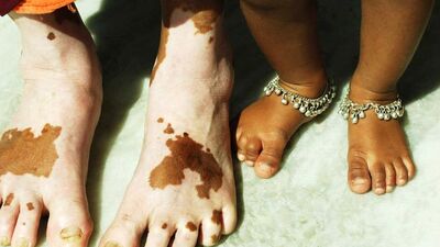 Yeni bulgular, vitiligo tedavisine umut oldu