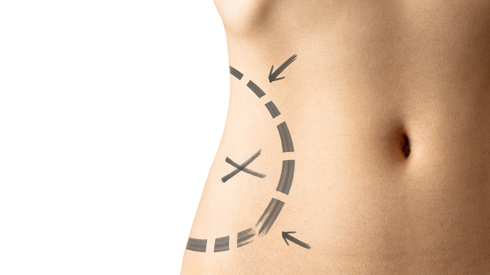 Liposuction zayıflama yöntemi değil!