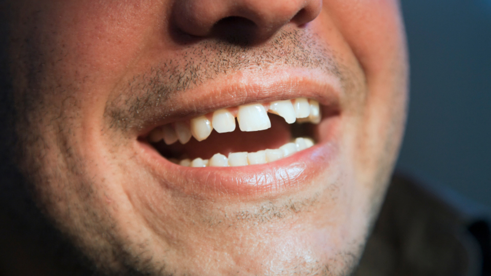 Diş kırığı deyip geçmeyin...