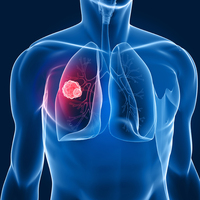 Sigara akciğer kanserini 25 kat arttırıyor