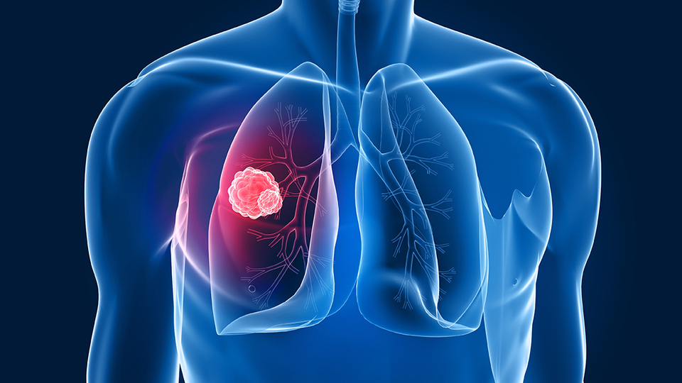 Sigara akciğer kanserini 25 kat arttırıyor