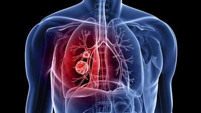 Bu kanser türü en çok erkeklerde görülüyor!