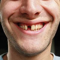 Diş eksikliği erken yaşlandırıyor