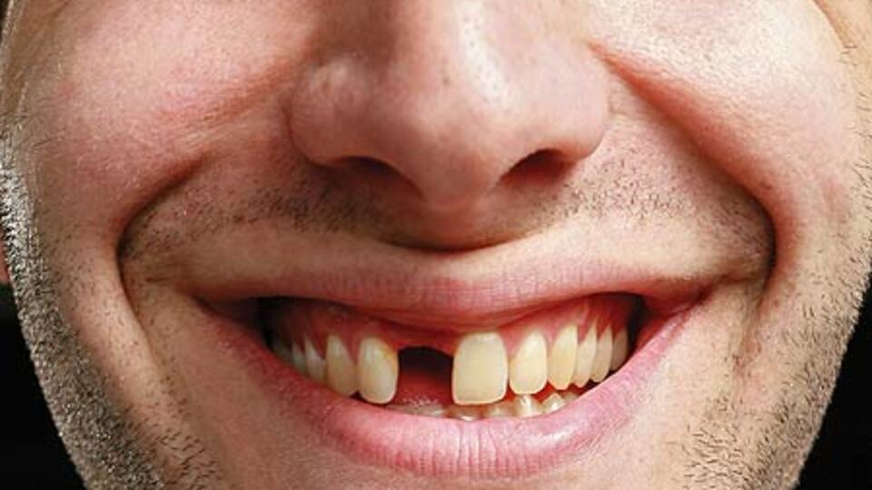 Diş eksikliği erken yaşlandırıyor