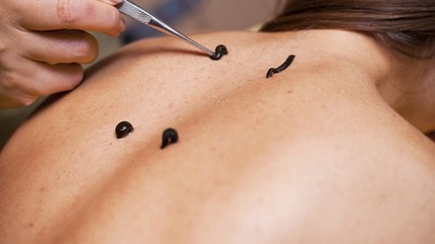 Merdiven altı 'sülük' tedavisi öldürebilir!