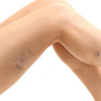 Kılcal damar genişlemeleri varis habercisi