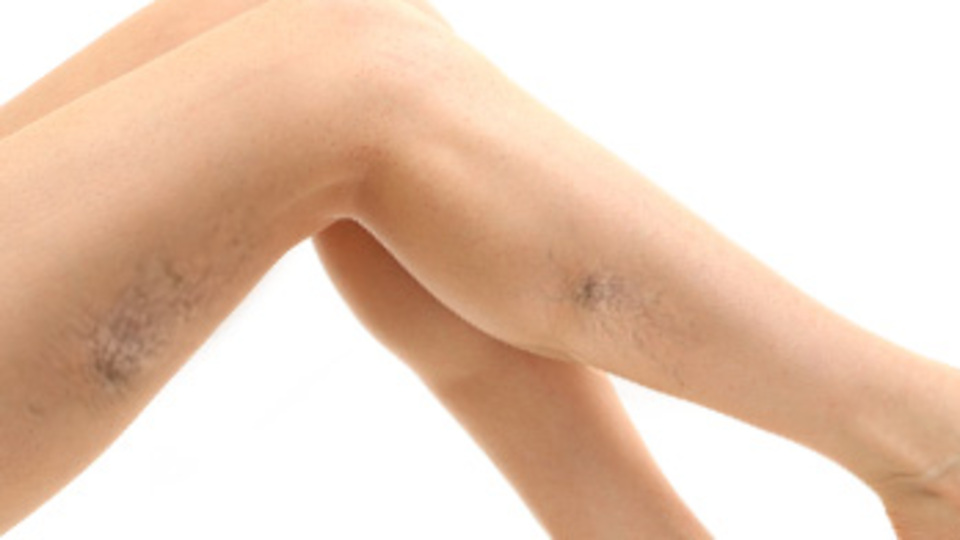 Kılcal damar genişlemeleri varis habercisi