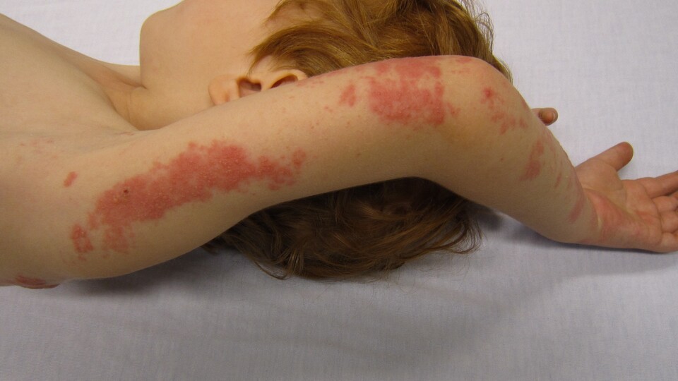 Çocuklarda "gece yanığı"na dikkat