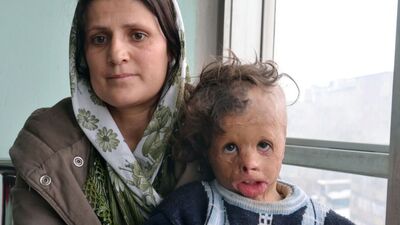 Yüzü yanan Demhat İliş yardım bekliyor