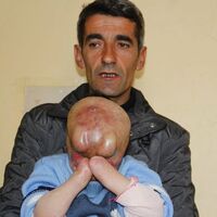 Minik Serkan yüz nakli bekliyor