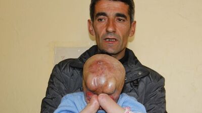 Minik Serkan yüz nakli bekliyor