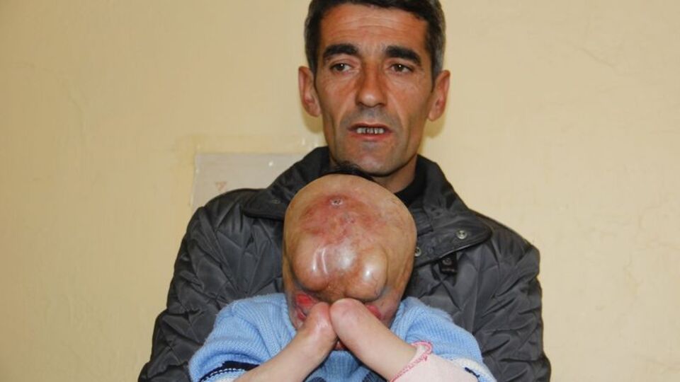 Minik Serkan yüz nakli bekliyor