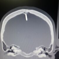 2.5 santimlik çiviyle 2 gün yaşadı