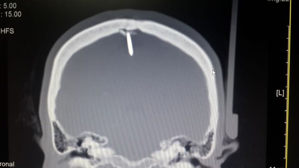 2.5 santimlik çiviyle 2 gün yaşadı