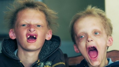 Türkiye'de bin vampir hastası var!