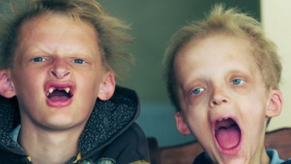 Türkiye'de bin vampir hastası var!