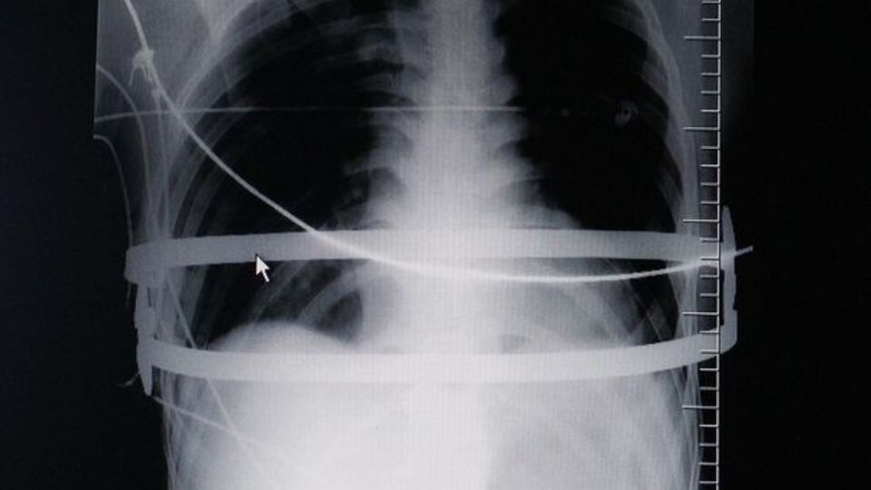 Göğsündeki çelik barlarla 2 yıl yaşayacak