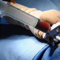 Kemik iliği naklinde Avrupa ile yarışıyor