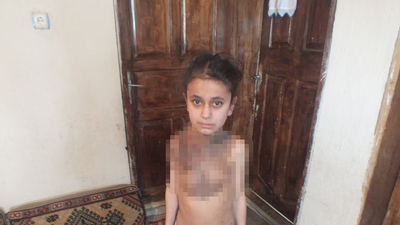 Tedavi olmazsa kolu kesilecek