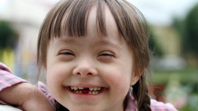 Down sendromu hastalık değildir!