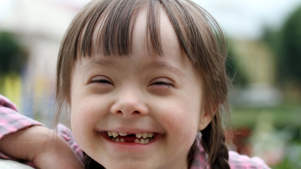 Down sendromu hastalık değildir!