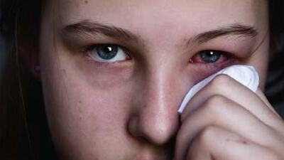 Baharla gelen göz alerjisine dikkat!