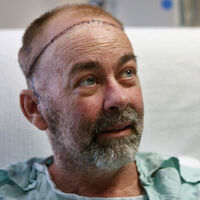 Dünyanın ilk kafatası nakli yapıldı!