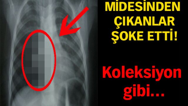 Midesinden çıkanlar şoke etti!