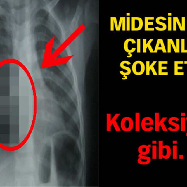Midesinden çıkanlar şoke etti!