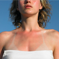 Güneş yanığı hakkında doğru bilinen yanlışlar