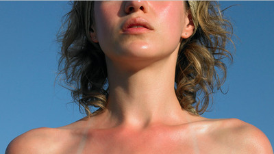 Güneş yanığı hakkında doğru bilinen yanlışlar