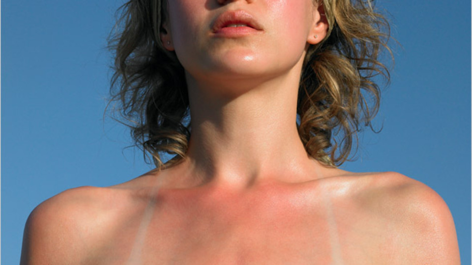 Güneş yanığı hakkında doğru bilinen yanlışlar