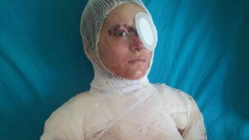 Kezzapla yaralanan Zehra yoğun bakımda