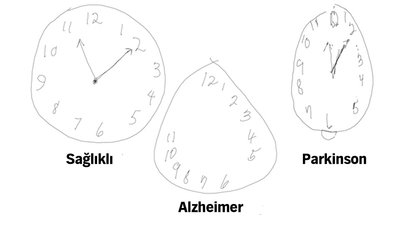 Alzheimer erken teşhisinde akıllı kalem yöntemi!