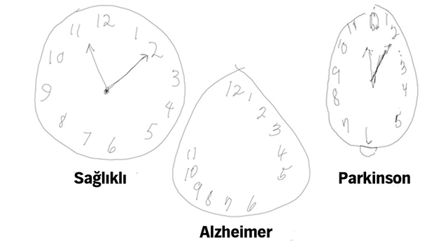 Alzheimer erken teşhisinde akıllı kalem yöntemi!
