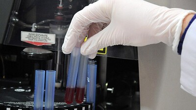 Sinir hasarının tedavisi bulundu