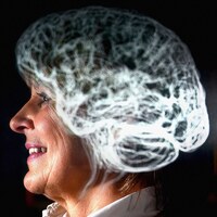 Bu hastalık beyni küçültüyor