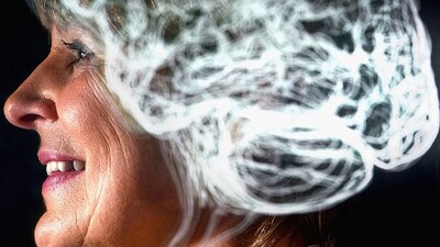 Bu hastalık beyni küçültüyor