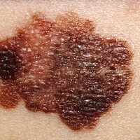 Melanom tedavisinde gelişmeler!