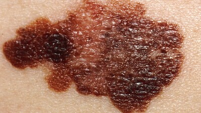 Melanom tedavisinde gelişmeler!