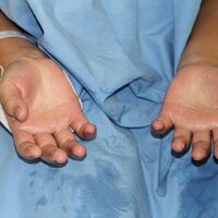 Avuç içi terlemesinden bakın nasıl kurtuldu?