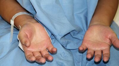 Avuç içi terlemesinden bakın nasıl kurtuldu?