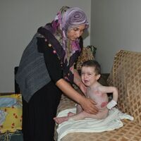 El ve ayakları eriyor!