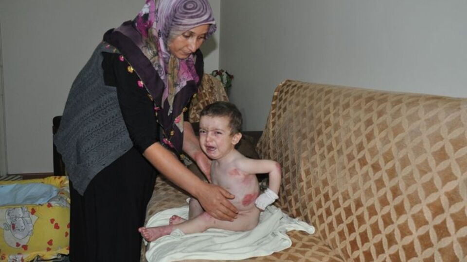 El ve ayakları eriyor!