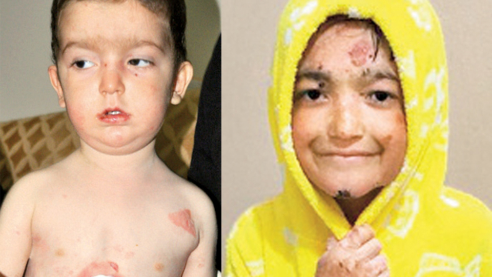 Kelebek çocuk Resul kurtuldu, sıra Ali'de