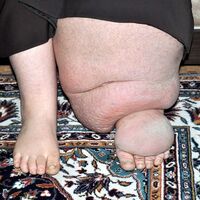 Fil Hastalığı yaşamını mahvetti!