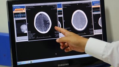 Baş ağrısı diye gitti, tümör çıktı